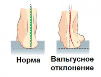 Вальгус_1